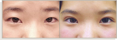 Photo Gallery Fountain Valley - For the Asian Face Image 03