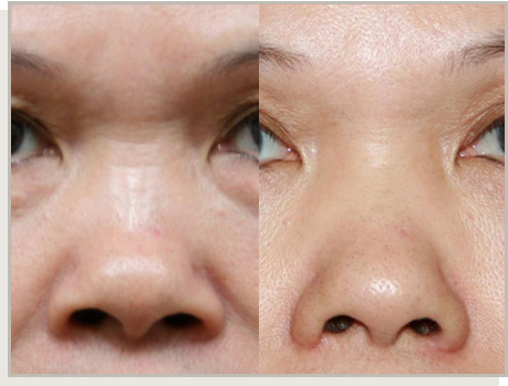 Photo Gallery Fountain Valley - For the Asian Face Image 05