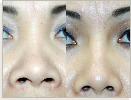 Photo Gallery Fountain Valley - For the Asian Face Image 06