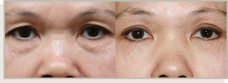 Photo Gallery Fountain Valley - For the Asian Face Image 07