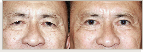 Photo Gallery Fountain Valley - For the Asian Face Image 08