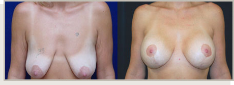 Photo Gallery Fountain Valley - Breast Lift and Reduction Image 01