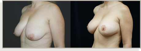 Photo Gallery Fountain Valley - Breast Lift and Reduction Image 10