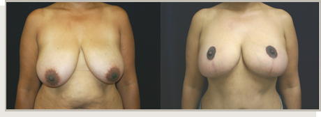 Photo Gallery Fountain Valley - Breast Lift and Reduction Image 11