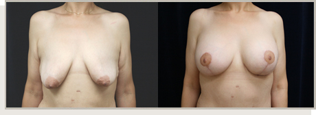 Photo Gallery Fountain Valley - Breast Lift and Reduction Image 12