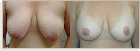 Photo Gallery Fountain Valley - Breast Lift and Reduction Image 14
