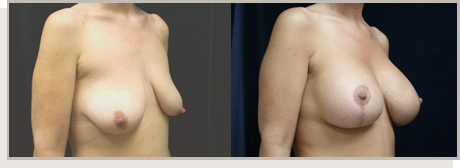 Photo Gallery Fountain Valley - Breast Lift and Reduction Image 15