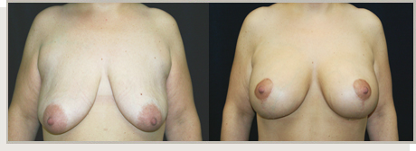 Photo Gallery Fountain Valley - Breast Lift and Reduction Image 16