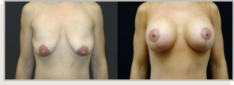 Photo Gallery Fountain Valley - Breast Lift and Reduction Image 02