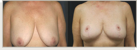 Photo Gallery Fountain Valley - Breast Lift and Reduction Image 03