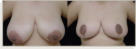Photo Gallery Fountain Valley - Breast Lift and Reduction Image 04