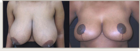 Photo Gallery Fountain Valley - Breast Lift and Reduction Image 05