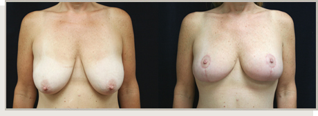 Photo Gallery Fountain Valley - Breast Lift and Reduction Image 06
