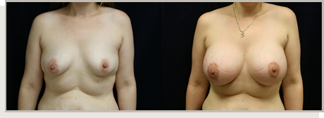 Photo Gallery Fountain Valley - Breast Lift and Reduction Image 08
