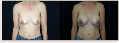 Photo Gallery Fountain Valley - Breast Lift and Reduction Image 09