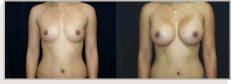 Photo Gallery Fountain Valley - Breast Augmentation Image 01