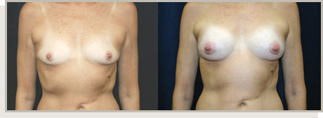 Photo Gallery Fountain Valley - Breast Augmentation Image 10