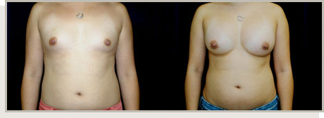 Photo Gallery Fountain Valley - Breast Augmentation Image 11