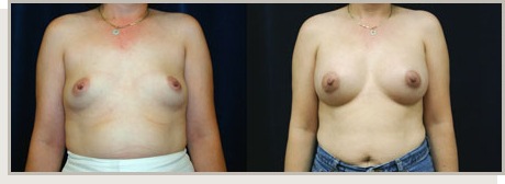 Photo Gallery Fountain Valley - Breast Augmentation Image 12