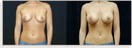 Photo Gallery Fountain Valley - Breast Augmentation Image 15