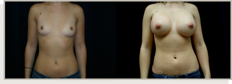 Photo Gallery Fountain Valley - Breast Augmentation Image 16