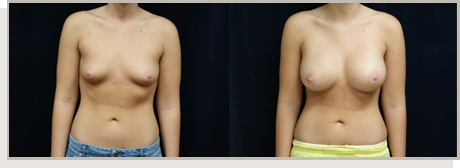 Photo Gallery Fountain Valley - Breast Augmentation Image 18