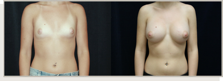 Photo Gallery Fountain Valley - Breast Augmentation Image 19