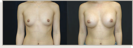 Photo Gallery Fountain Valley - Breast Augmentation Image 02