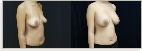 Photo Gallery Fountain Valley - Breast Augmentation Image 20