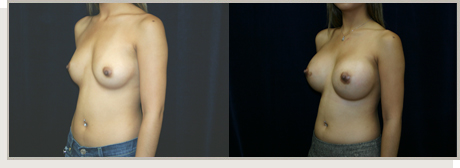 Photo Gallery Fountain Valley - Breast Augmentation Image 21