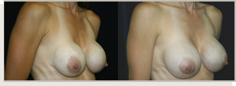 Photo Gallery Fountain Valley - Breast Augmentation Image 23