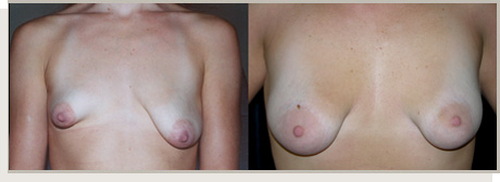Photo Gallery Fountain Valley - Breast Augmentation Image 24