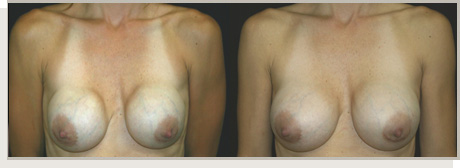 Photo Gallery Fountain Valley - Breast Augmentation Image 25