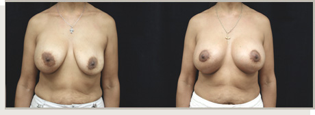 Photo Gallery Fountain Valley - Breast Augmentation Image 26