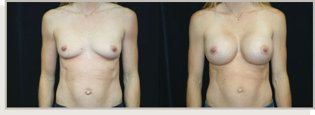 Photo Gallery Fountain Valley - Breast Augmentation Image 03