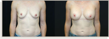 Photo Gallery Fountain Valley - Breast Augmentation Image 04