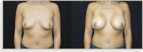 Photo Gallery Fountain Valley - Breast Augmentation Image 05