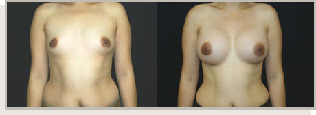 Photo Gallery Fountain Valley - Breast Augmentation Image 07