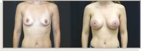 Photo Gallery Fountain Valley - Breast Augmentation Image 08