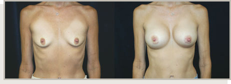 Photo Gallery Fountain Valley - Breast Augmentation Image 09