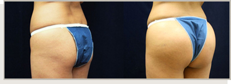 Photo Gallery Fountain Valley - Butt Augmentation Image 01