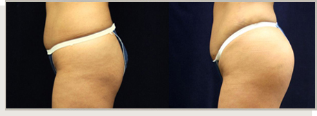 Photo Gallery Fountain Valley - Butt Augmentation Image 02