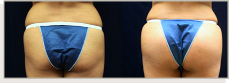 Photo Gallery Fountain Valley - Butt Augmentation Image 03
