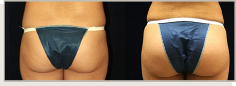 Photo Gallery Fountain Valley - Butt Augmentation Image 04