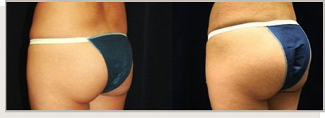 Photo Gallery Fountain Valley - Butt Augmentation Image 05