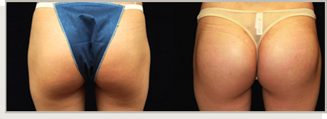 Photo Gallery Fountain Valley - Butt Augmentation Image 07