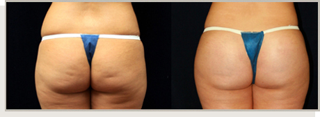 Photo Gallery Fountain Valley - Butt Augmentation Image 08