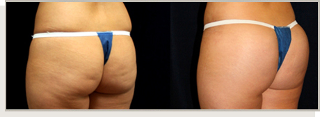 Photo Gallery Fountain Valley - Butt Augmentation Image 09