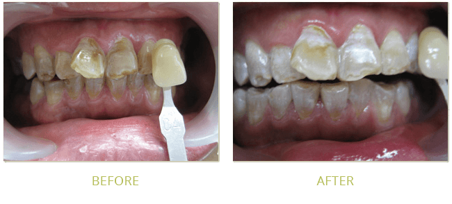 Smile Gallery Before After 11