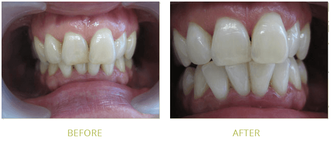 Smile Gallery Before After 01